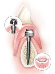 Ortho Implant